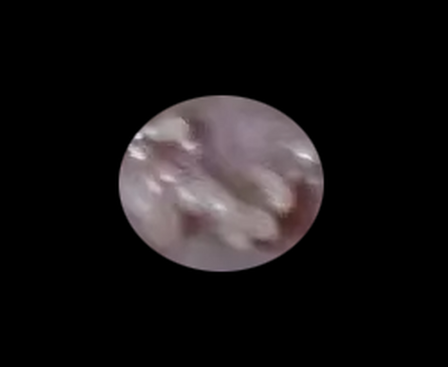 男子肛周疯狂长"菜花",否认x生活传染,自己不知道怎么会这样.