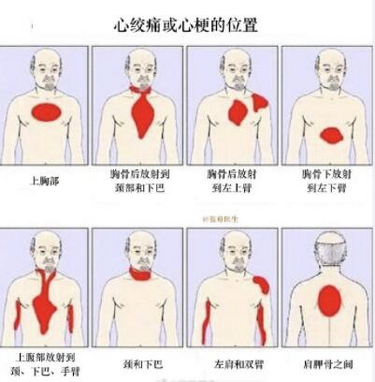 常见的心梗的各种表现,一图概括
