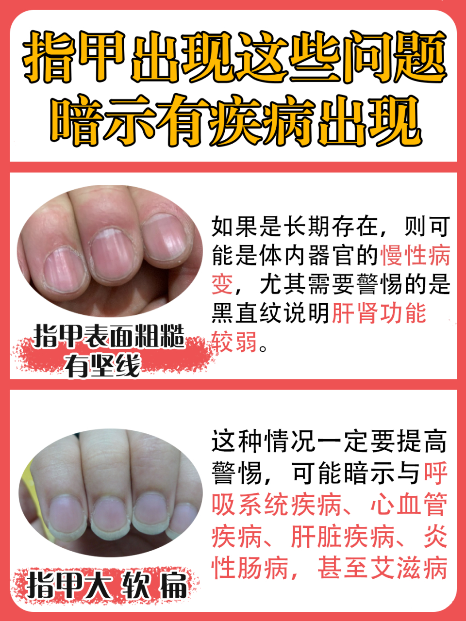 定期自查指甲状况也能了解到自身身体健康,今天给大家分享一份健康小