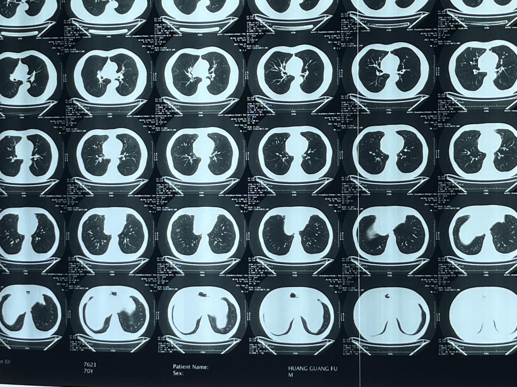 三个月,6mm肺结节消了 这位患者6月份检查出6mm磨玻璃结节,和5mm实性
