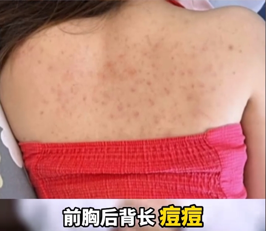 前胸后背长痘痘,一碰就痛,有时有点痒