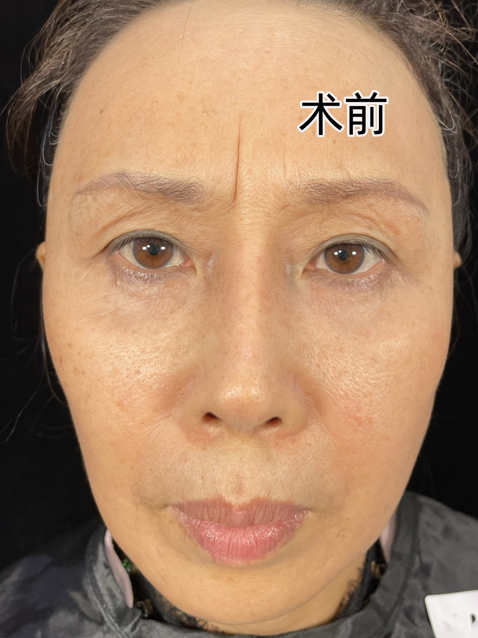 眉间川字纹,也被称为"愁纹"或"愁眉苦脸纹",是因为长期皱眉,愁思或