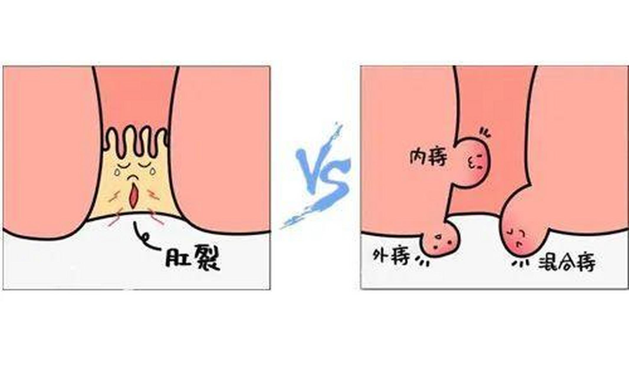 在观察肛门时,局部可见一些皮肤裂口;而痔疮通常是由于肛管静脉充血