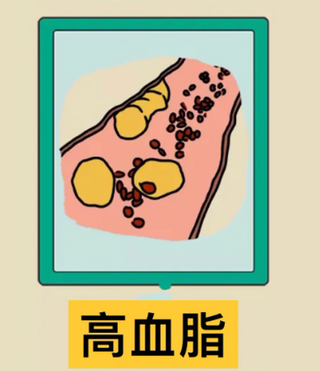 高血脂人群可以增加不饱和脂肪的摄入,好的脂肪来源包括油菜籽油,橄榄