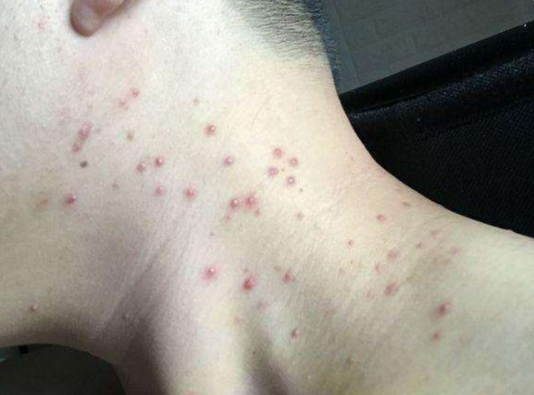 前胸后背长痘痘,这个方法处理有效  大家有过前胸后背长痘痘的经历吗?