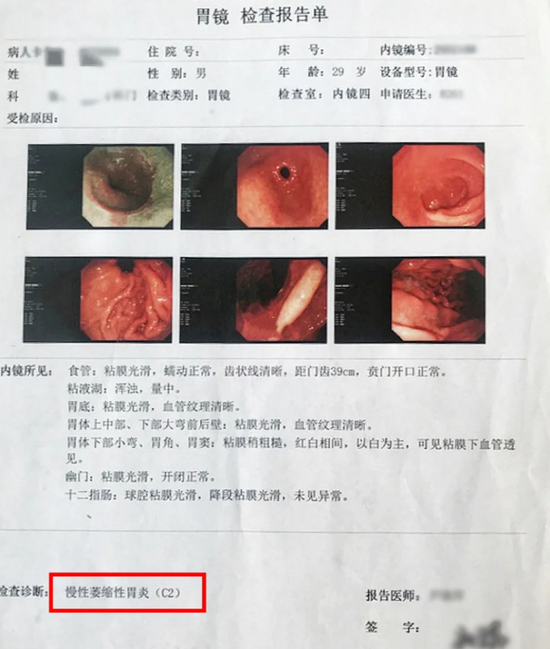 萎缩性胃炎c2,29岁男性患者,3个月萎缩消失 患者章先生,29岁,今年3月