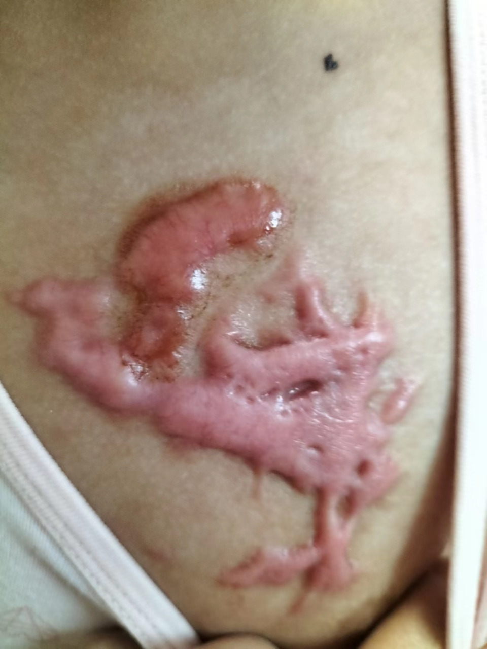 假性疤痕经过一段时间会自动消失;真性疤痕分为凹陷性和增生性疤痕