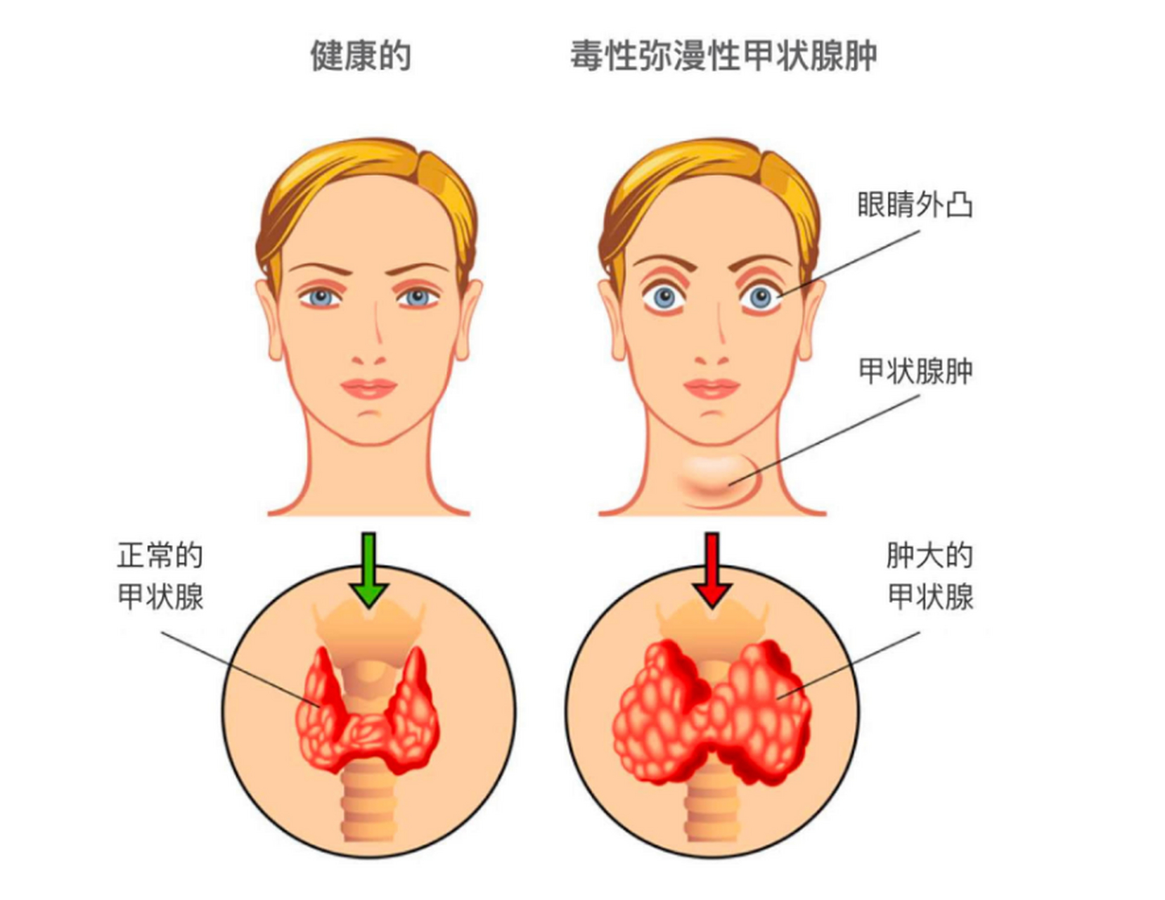 甲状腺癌早期症状图片
