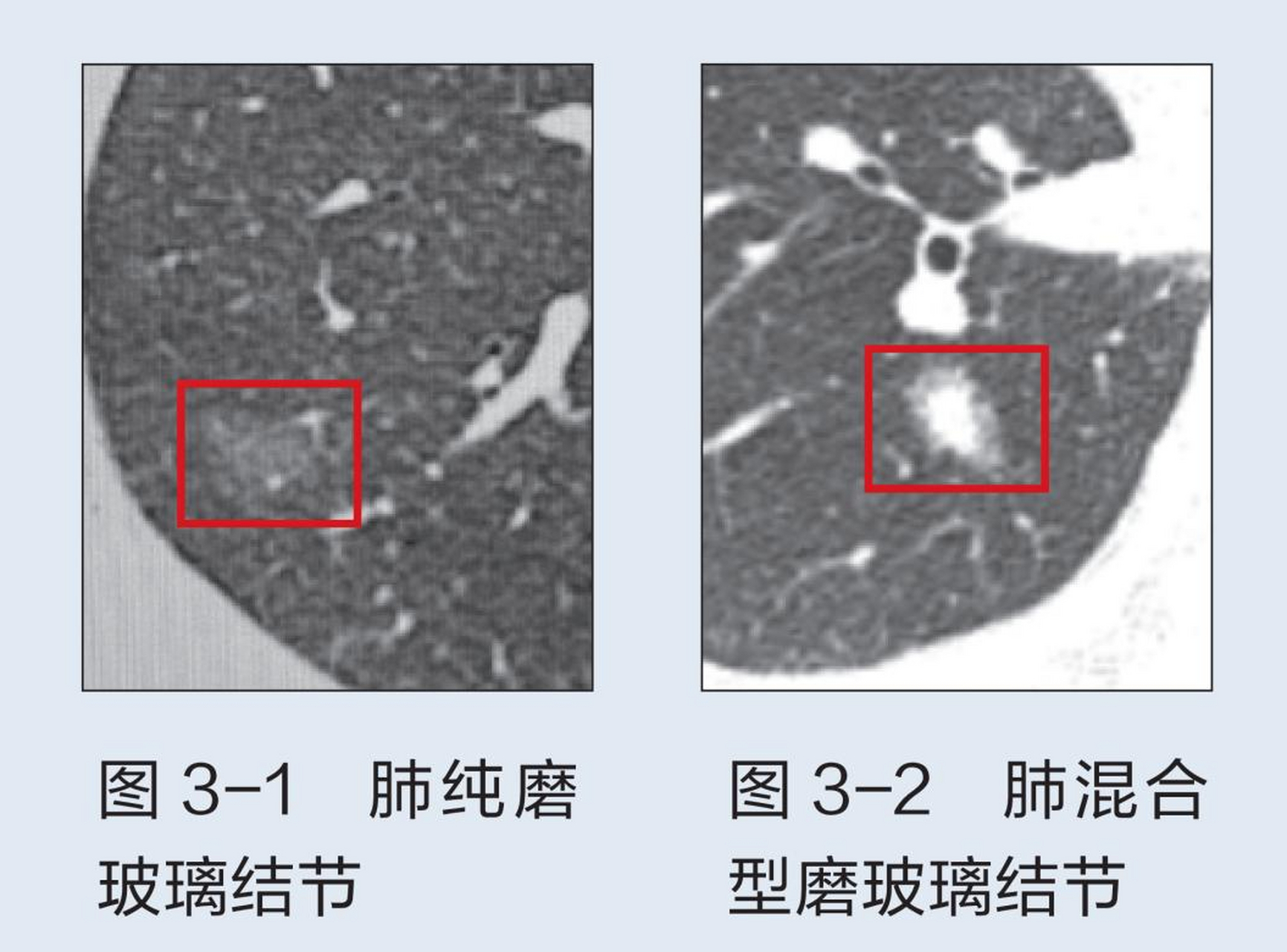 恶性磨玻璃结节图片图片