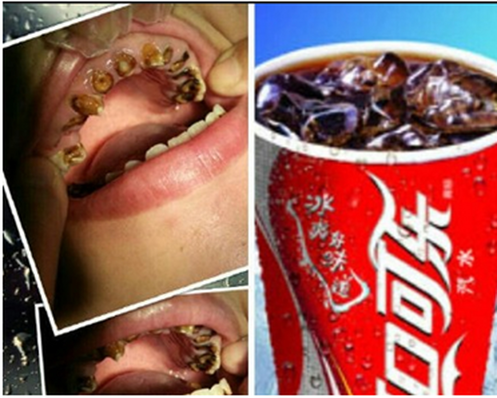 由于小钟长期喜欢喝碳酸饮料,形成了我们所俗称的可乐牙;对其生活造成