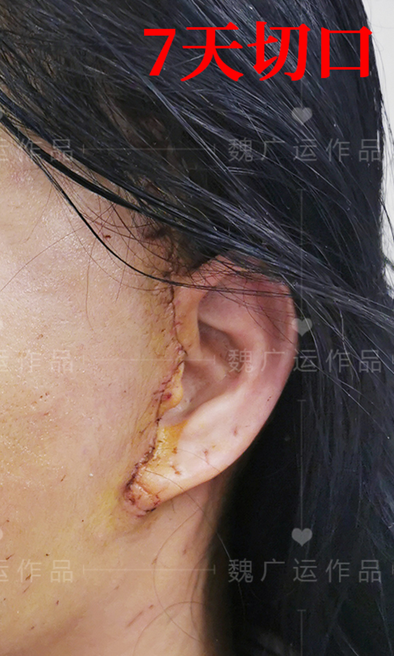 一狠心自己做了拉皮手术,变化太大,身边闺蜜"没敢认"!