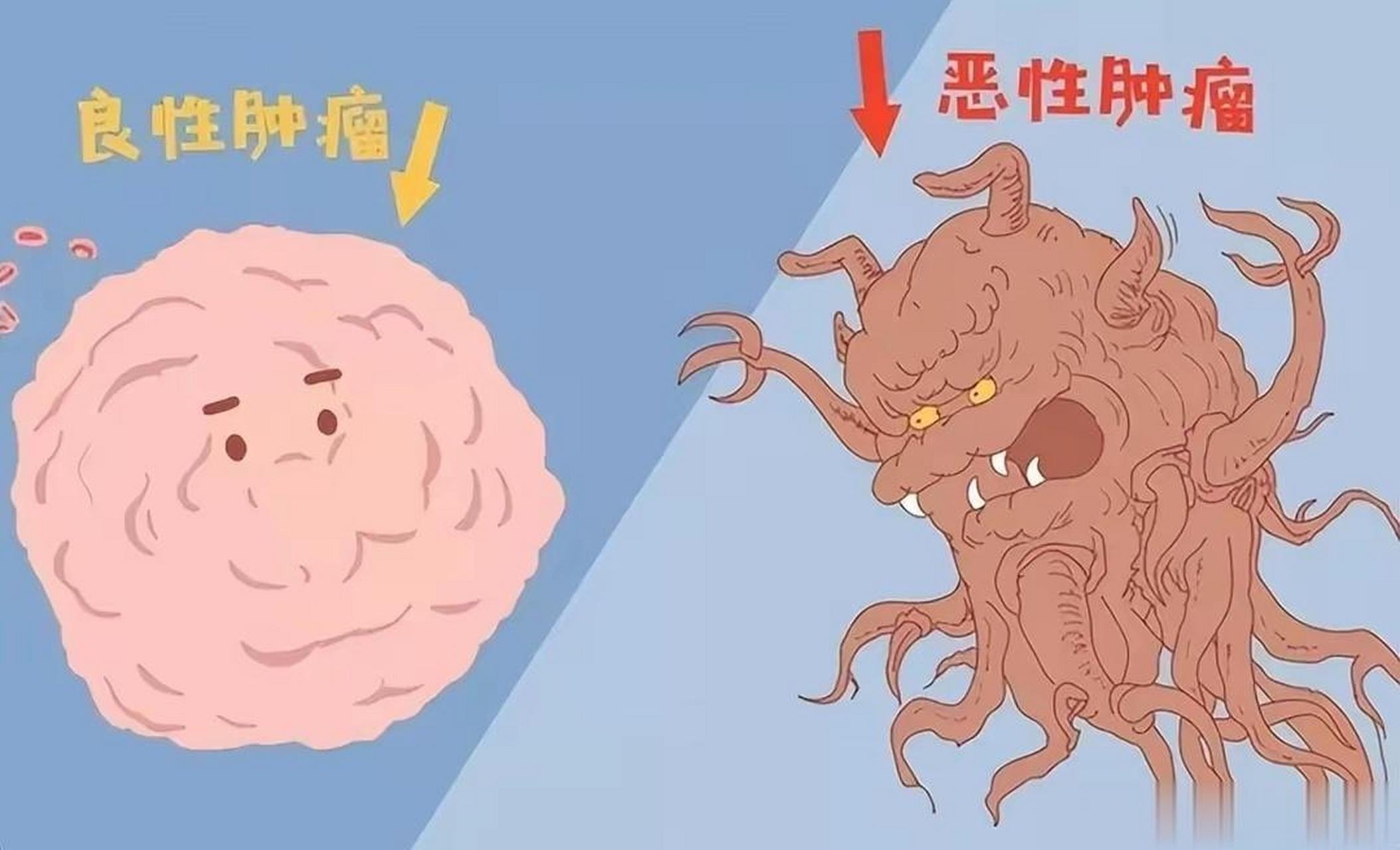 哪种肿瘤会转移?