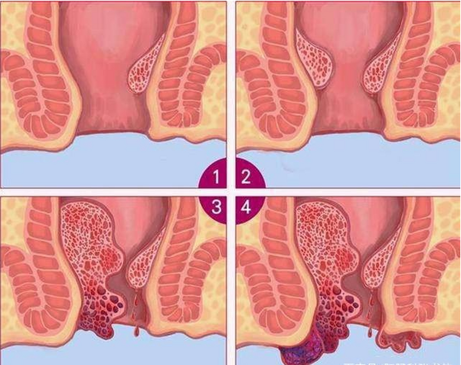 正常肛门图片痔疮图片