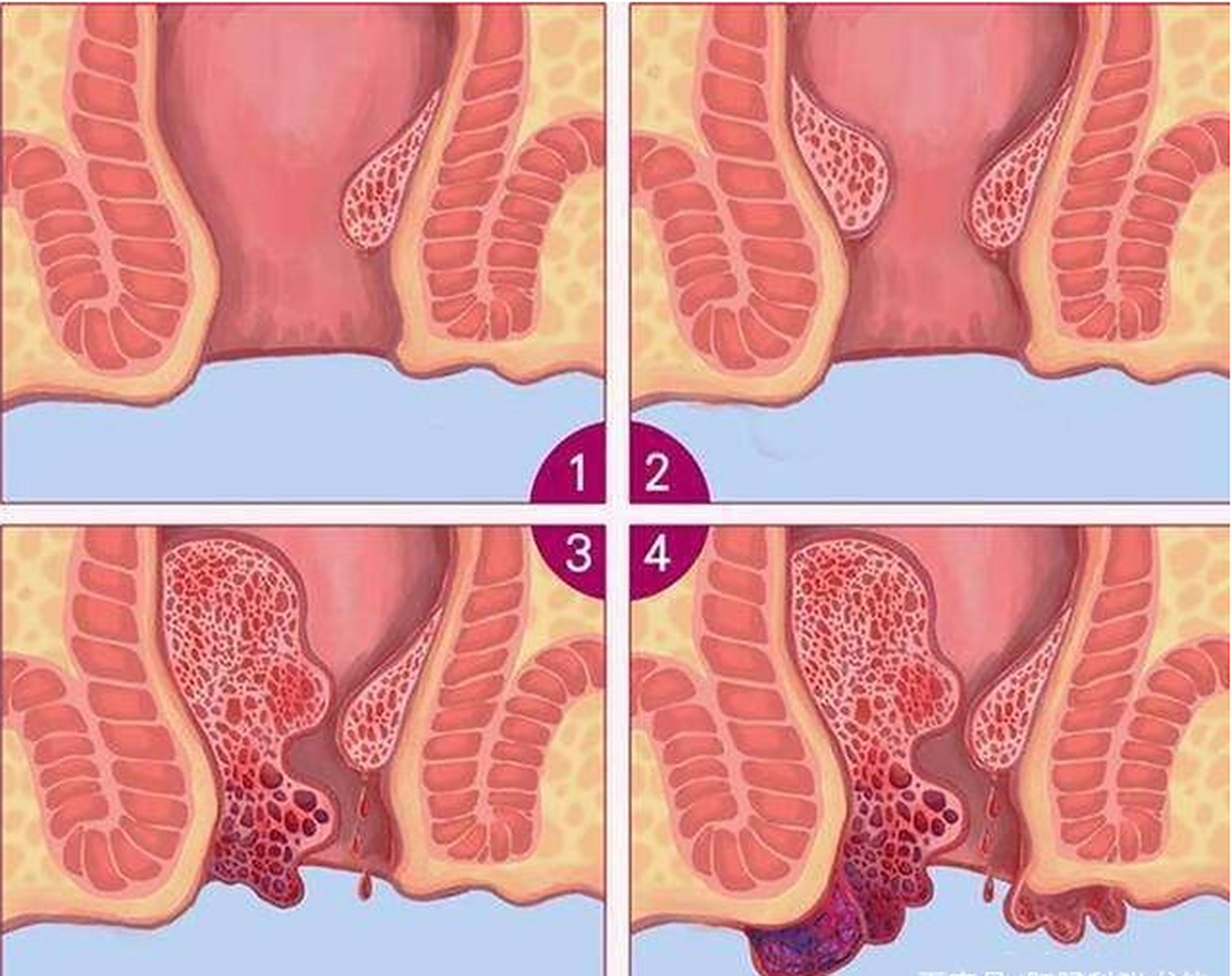 痔疮肿痛难受是吧?害怕做手术吗?