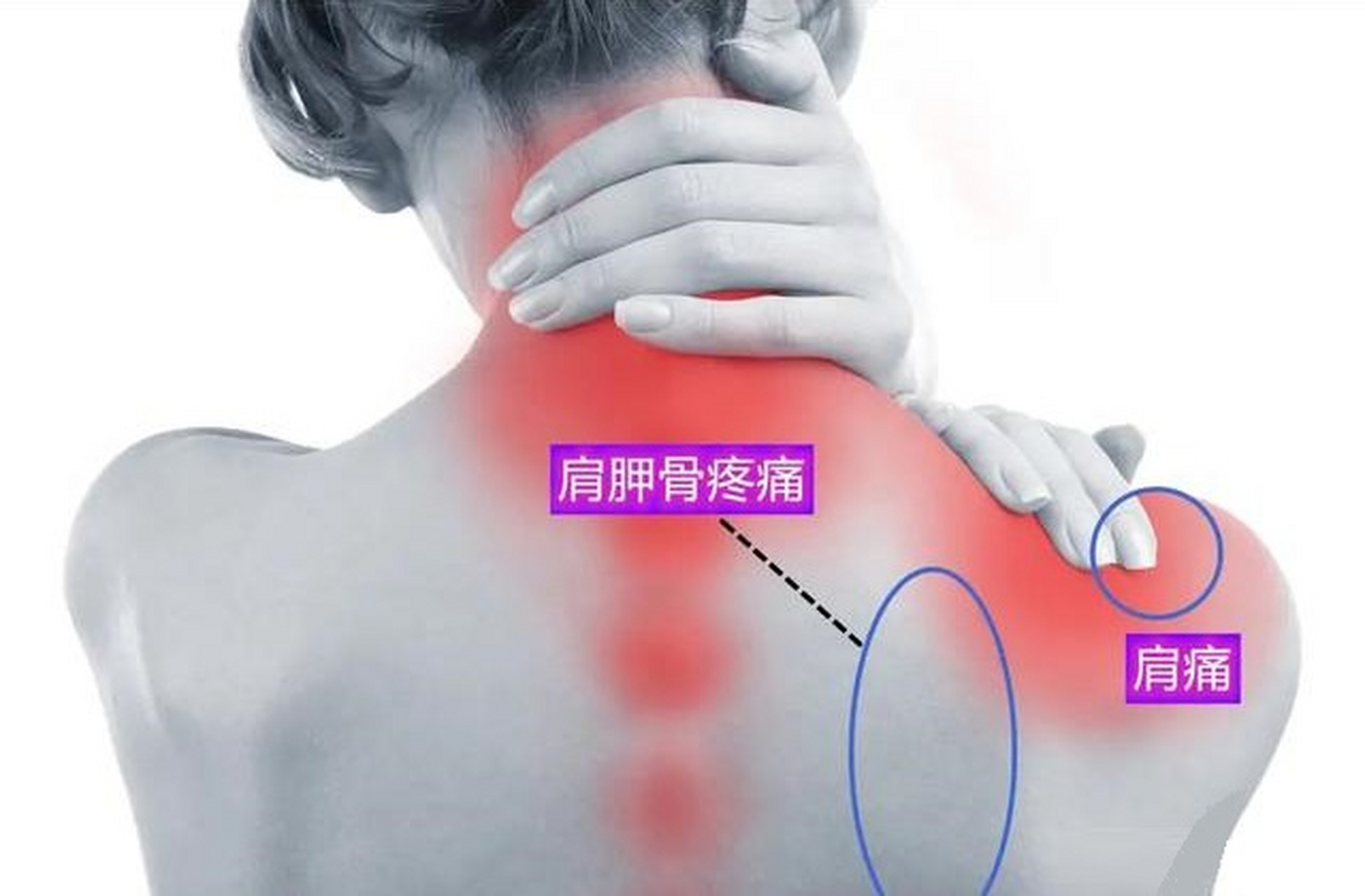 两个常见原因  [大哭] 1,能找到痛点——肌肉受损 如果你觉得肩胛骨缝