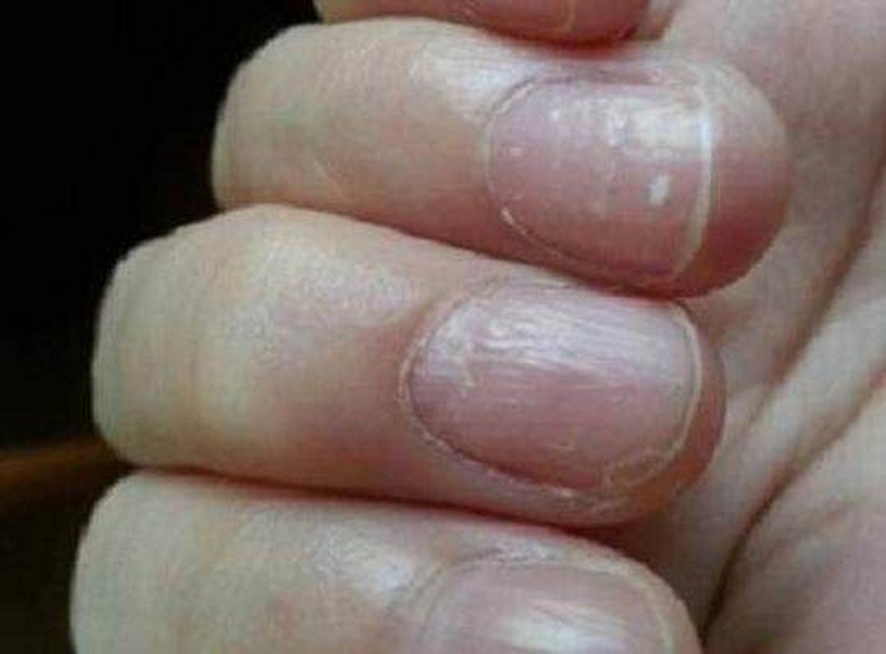 有传言称,指甲上有白点说明缺钙,体内有寄生虫?