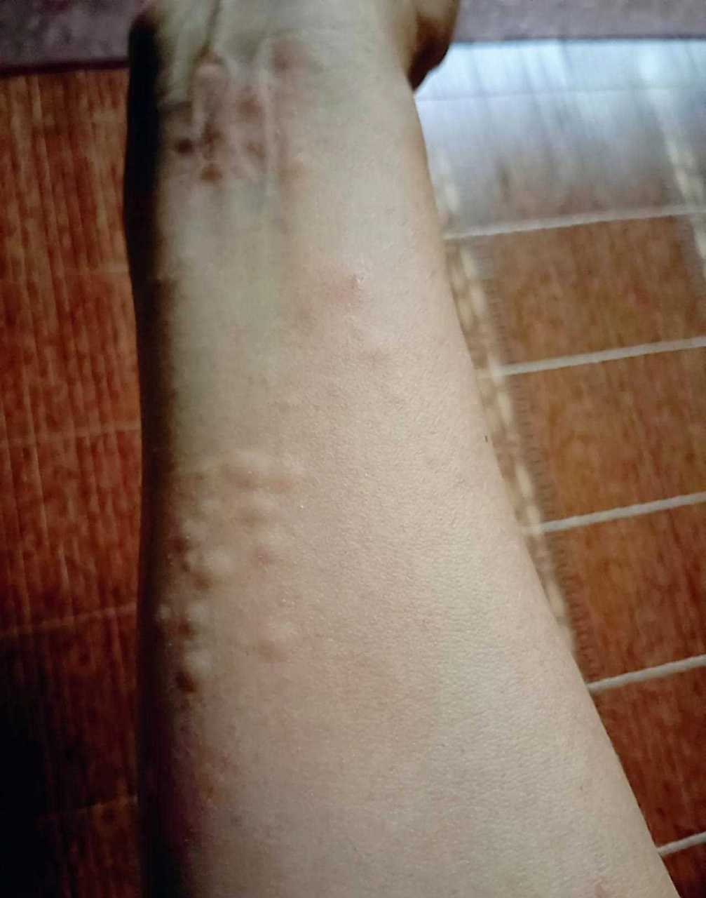 我的胳膊这两天起疙瘩,痒痒得很,挠烂的淌黄色的水,腿上肚皮上也有