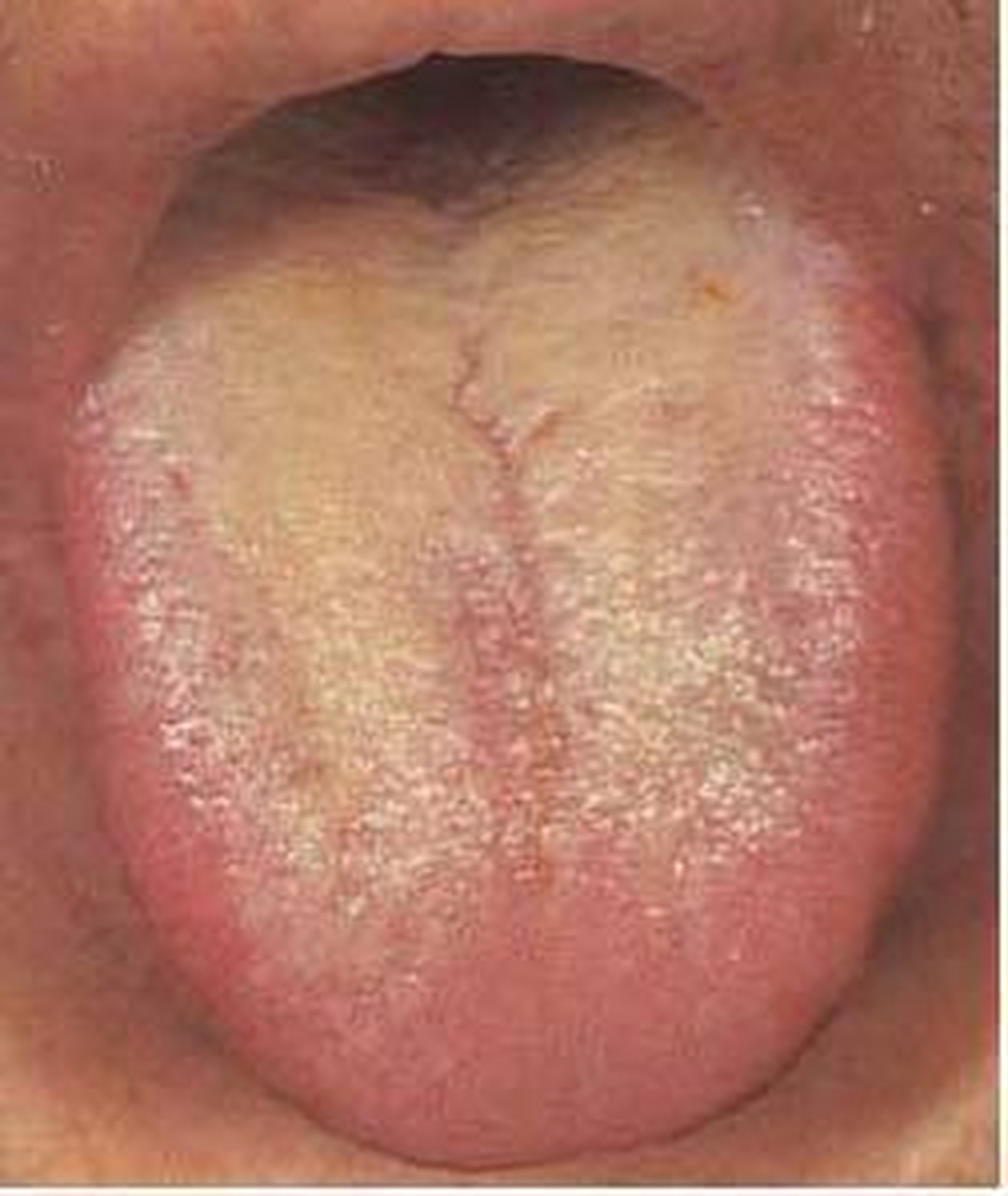 舌头边缘红,舌面中后部舌苔厚腻,是肝胆湿热了    大家可以看看这位