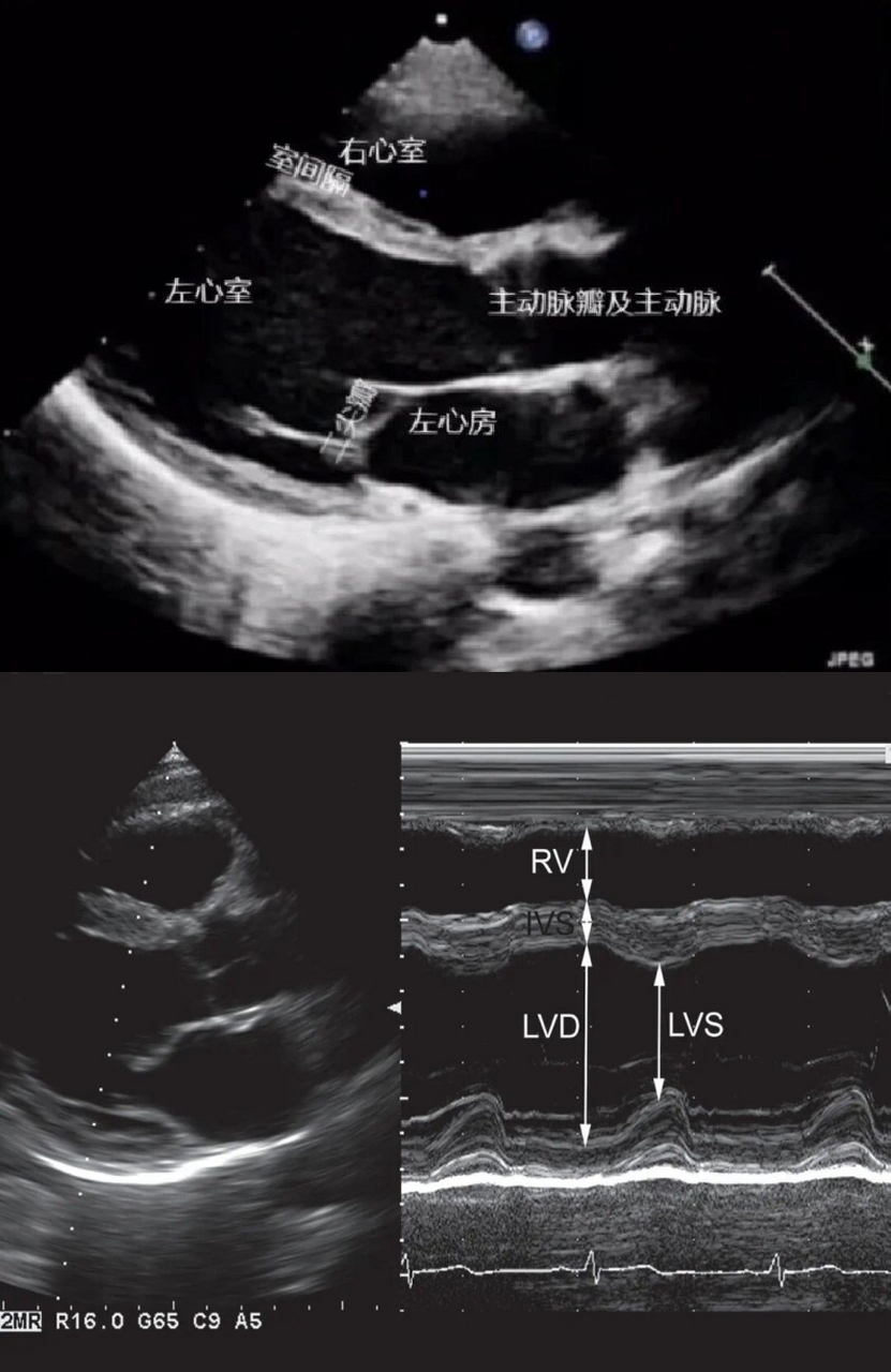 心脏超声八个标准切面图片
