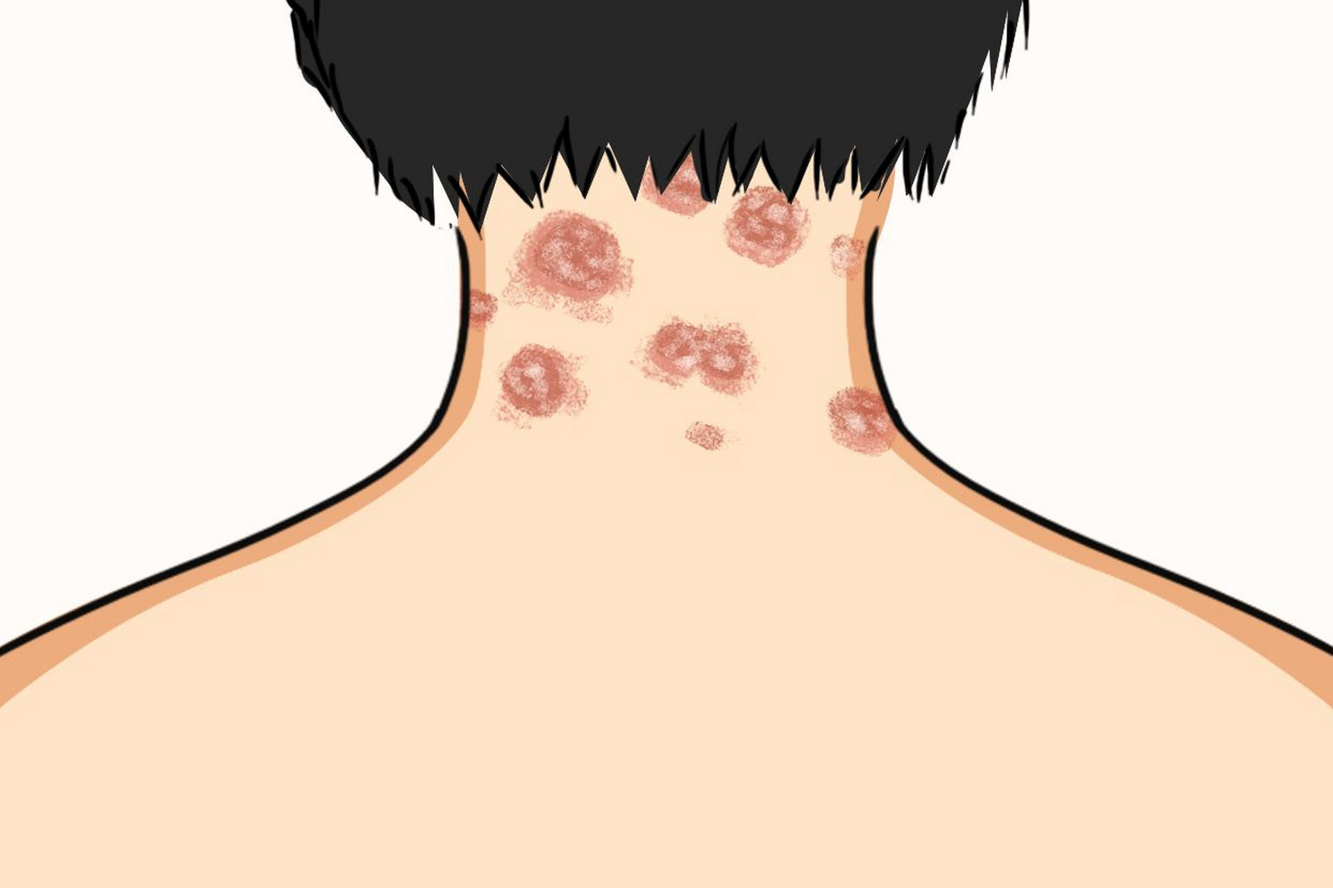 体癣# #足癣# #手足脚癣# #体股癣#  由真菌感染而引起的皮肤病,袄è