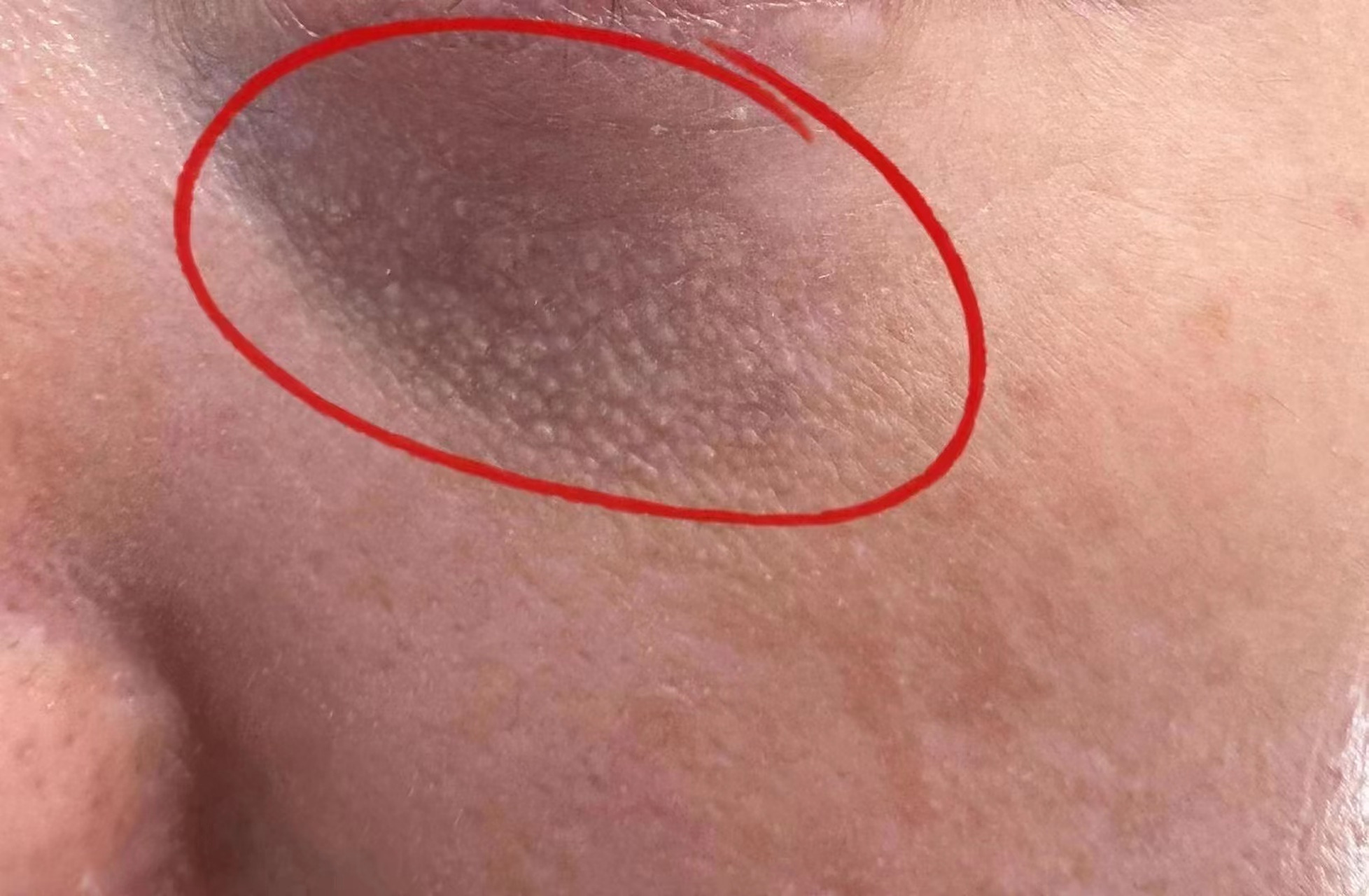 【长在眼睛下面的小疙瘩到底是什么?