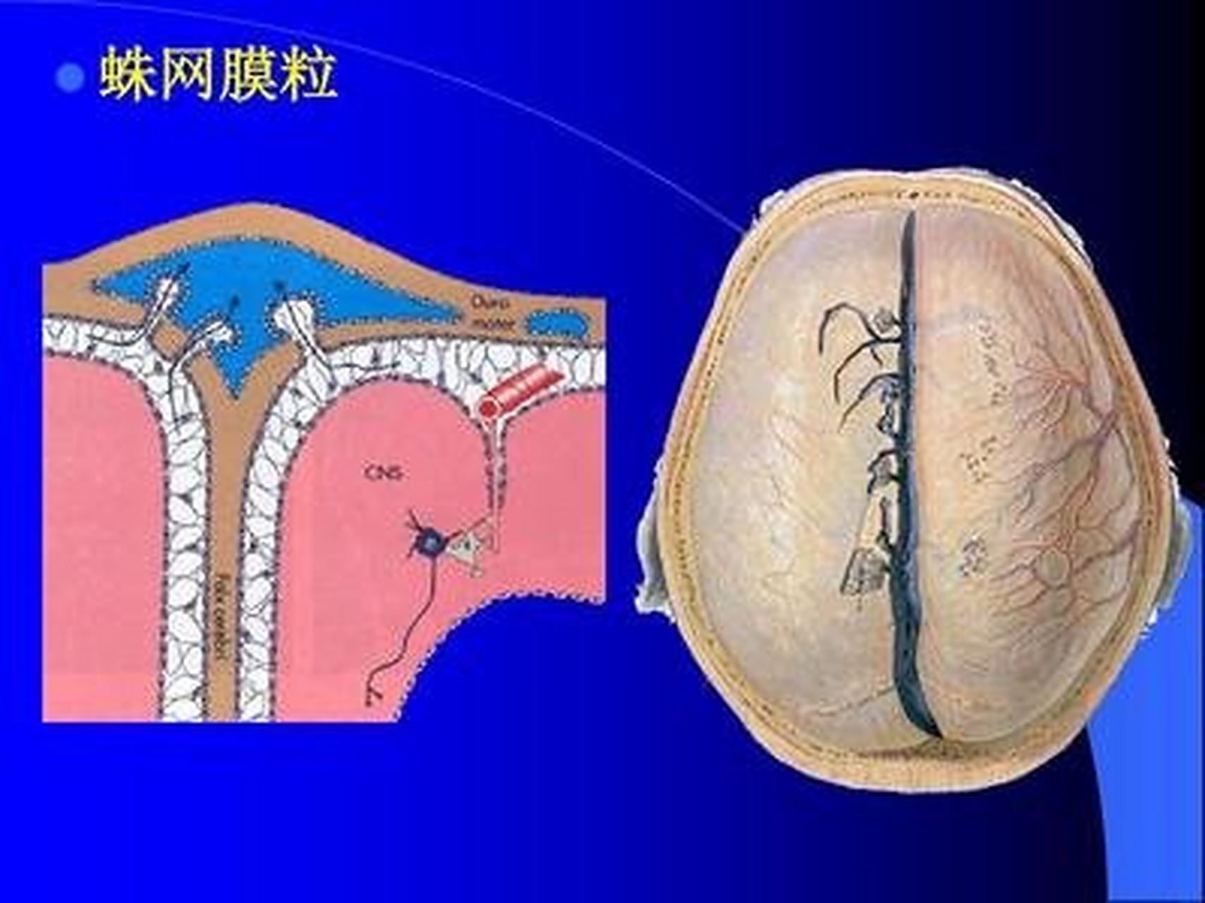 蛛网膜颗粒不是疾病,是人体内正常的组织结构.