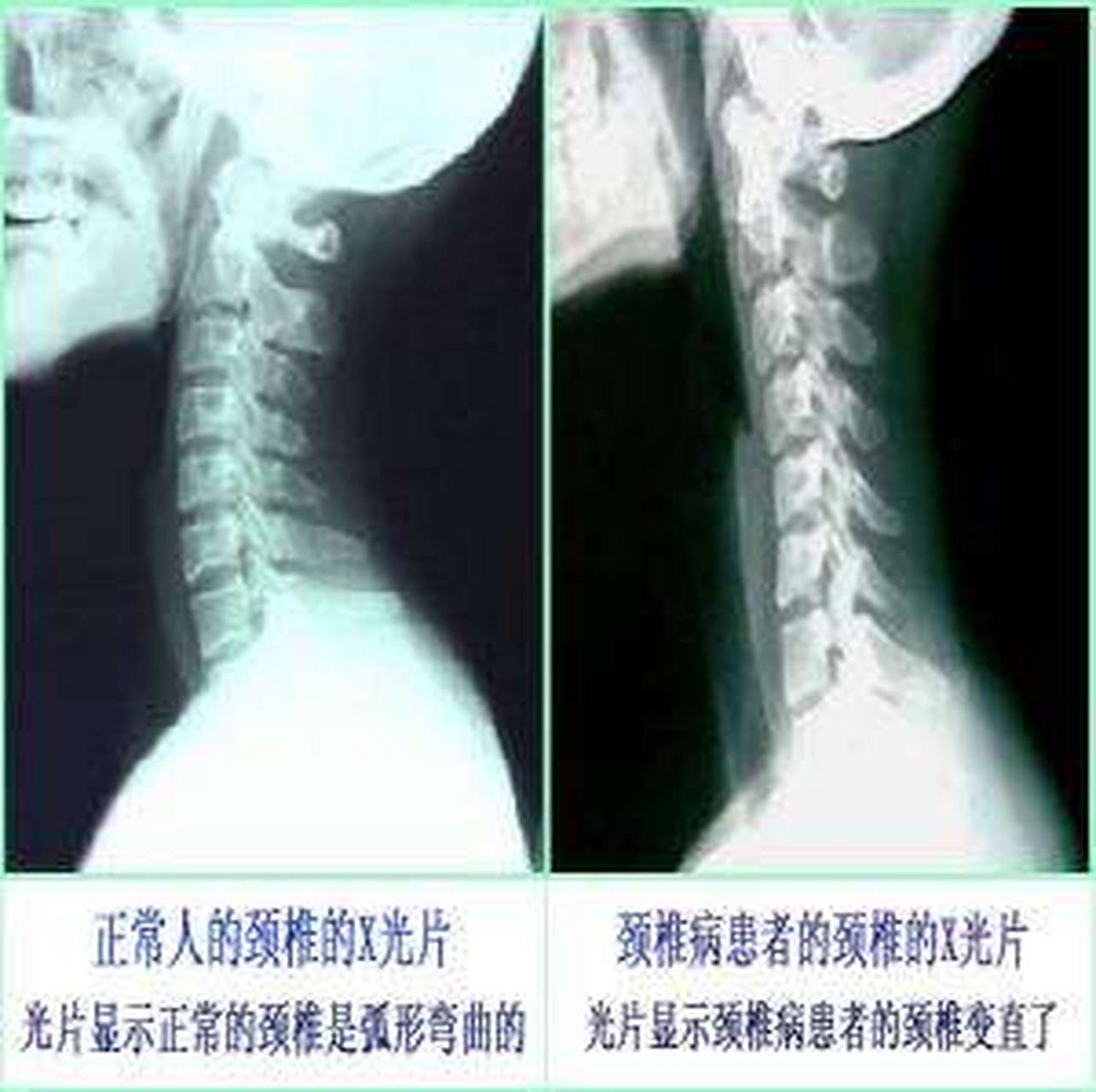 第二步就是根据你的照片,来判断你的颈椎问题属于哪个类型的—比如