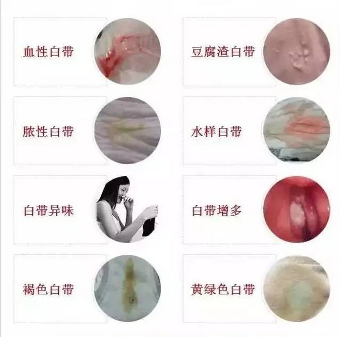 白带发黄发臭,可能是宫颈炎,霉菌性阴道炎,子宫