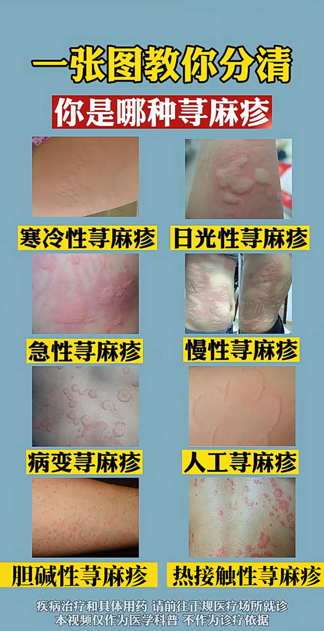 西安肤康享麻疹医院/不洗澡会不会引起荨麻疹/麻疹怎么治疗最快的方法