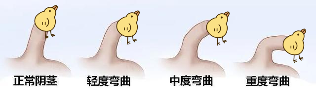 阴茎弯曲是不是病?