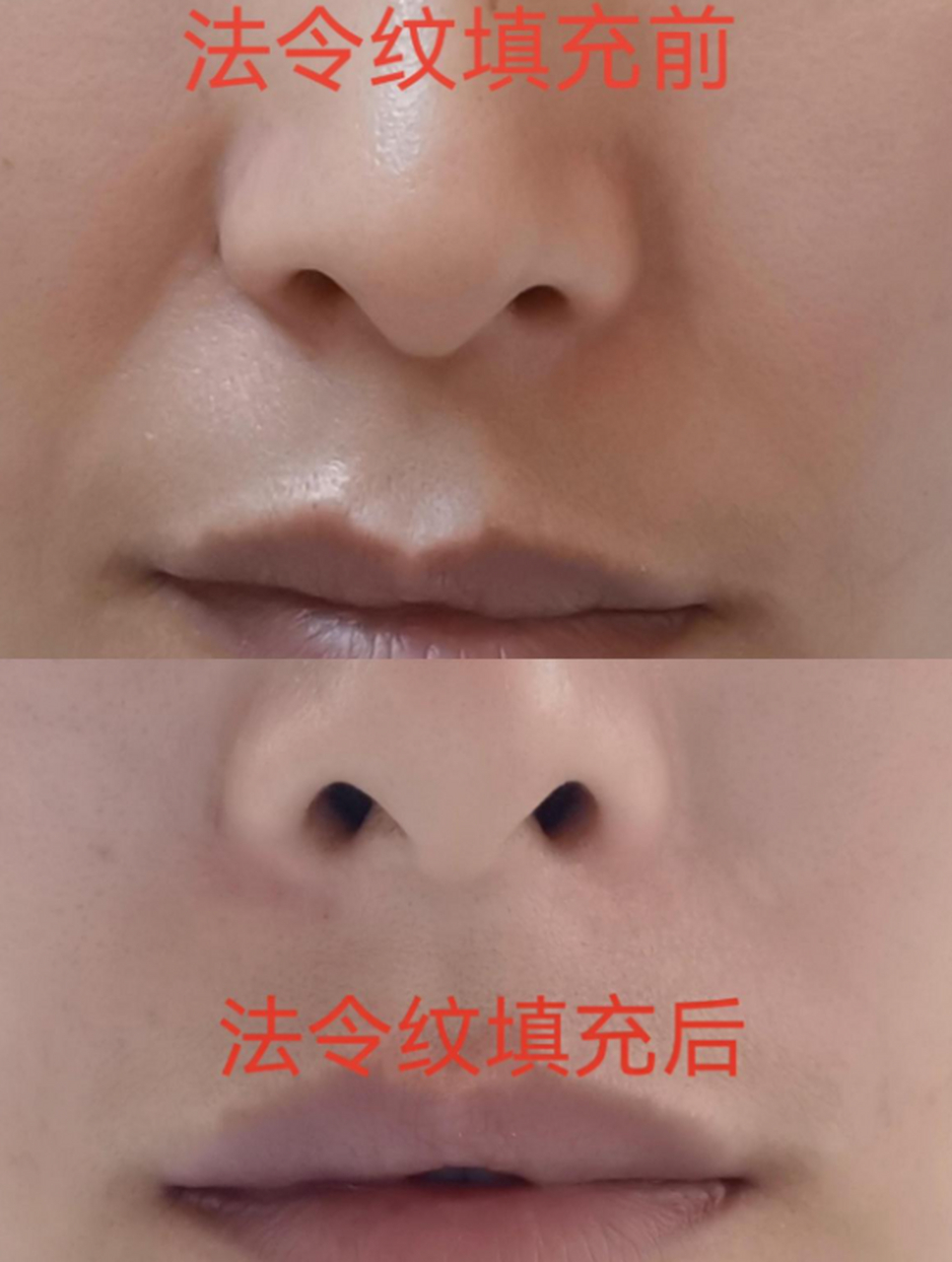 法令纹填充一般使用的是比较柔软的材料,因为法令纹周围没有骨骼支撑