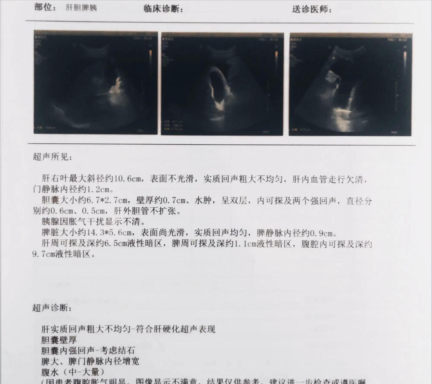 肝实质回声光点细腻,分布均匀,肝胆胰脾未见异常:正常报告;  2.