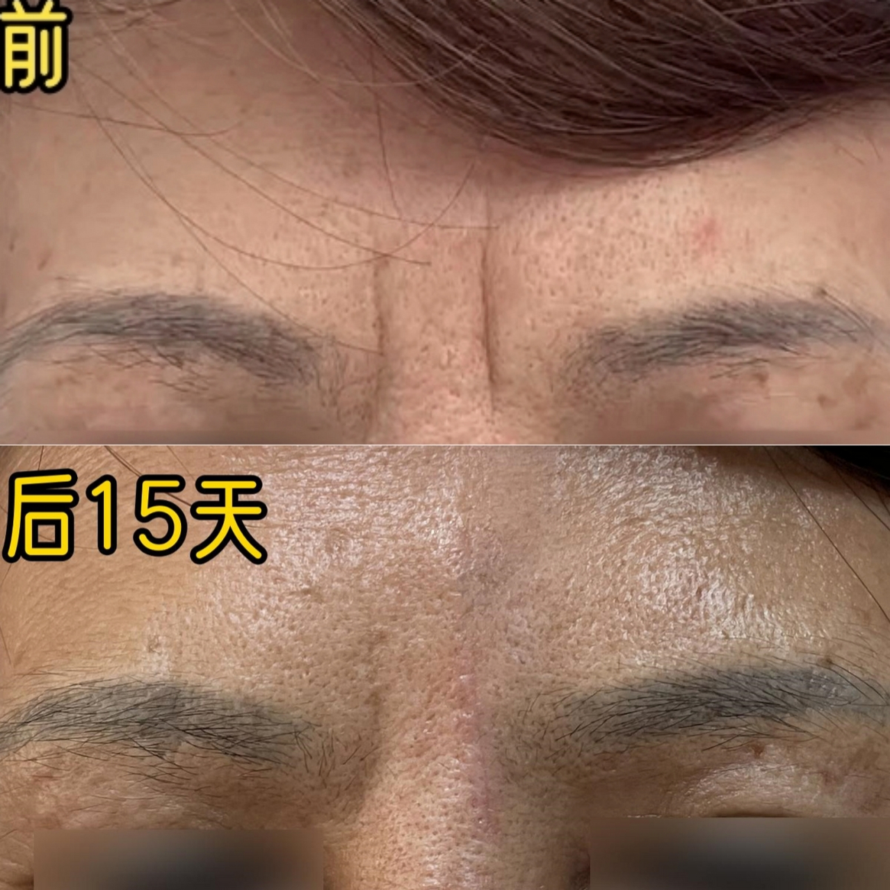 很多网友说:"#川字纹# 切除疤痕太重了,做这个没有意义.