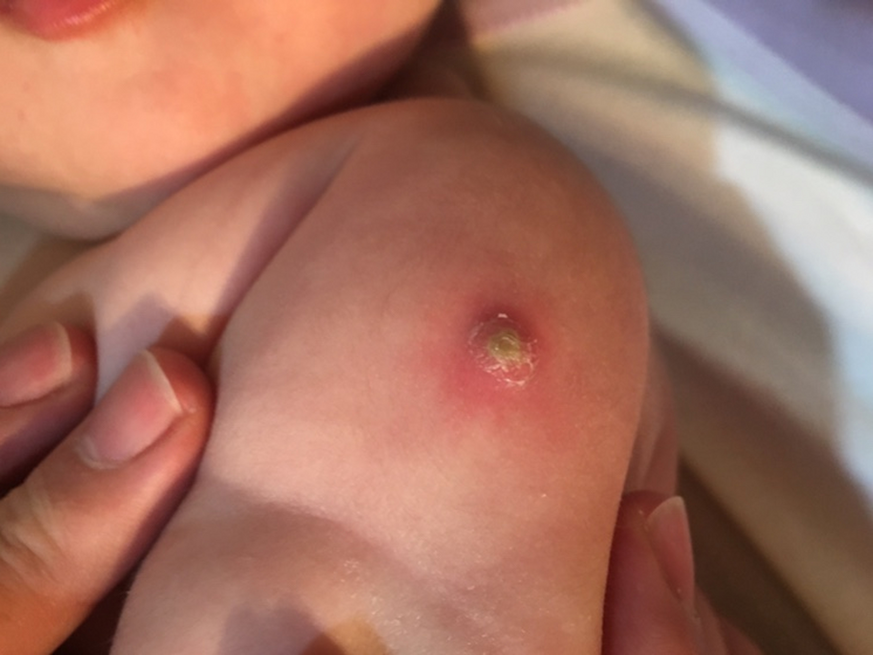 新生儿出生后会接种卡介苗,这是预防儿童结核病的减毒活疫苗,可明显