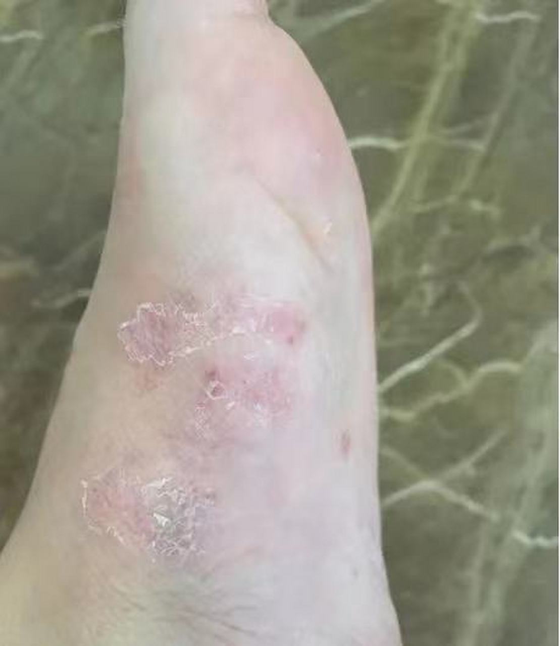 梅毒引起的铜红色斑疹,一般两个脚都有,不痛不痒,主要是治疗梅毒