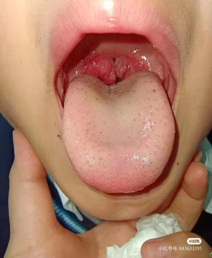 立秋了,季节交替最容易引起扁桃体发炎,原因有很多,家长可以看看自家