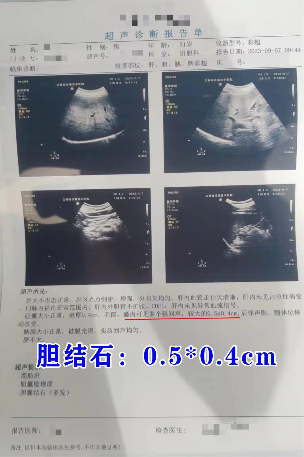 4cm,毛糙,有胆囊炎问题,多发胆结石,较大者0.5*0.