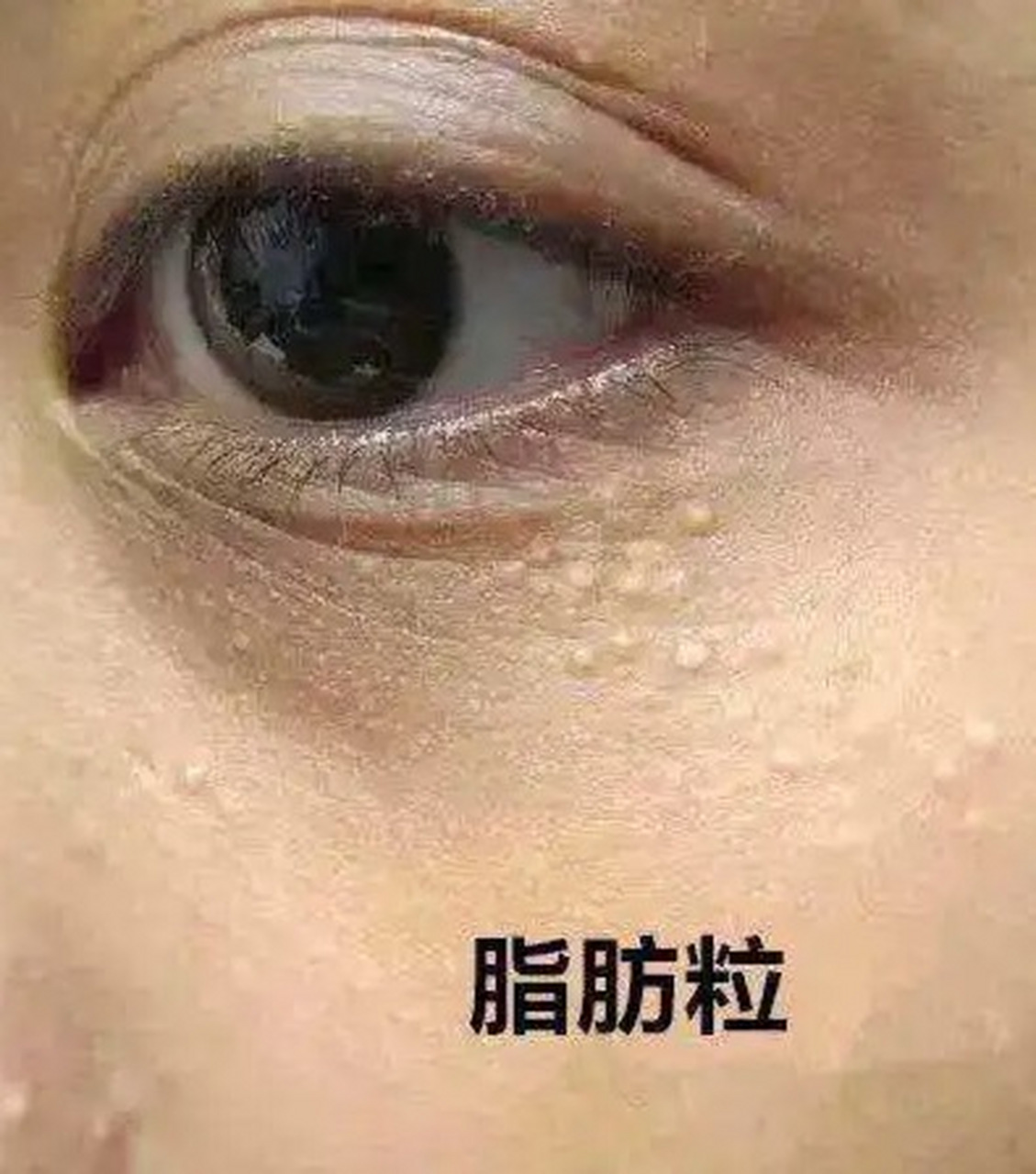 脂肪粒是一种常见的眼部问题,它们通常是由于皮肤的油脂堵塞了小的