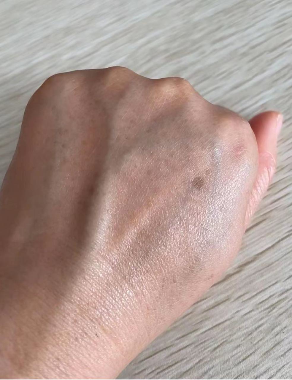 手上有老年斑消除最好的方法有哪些?