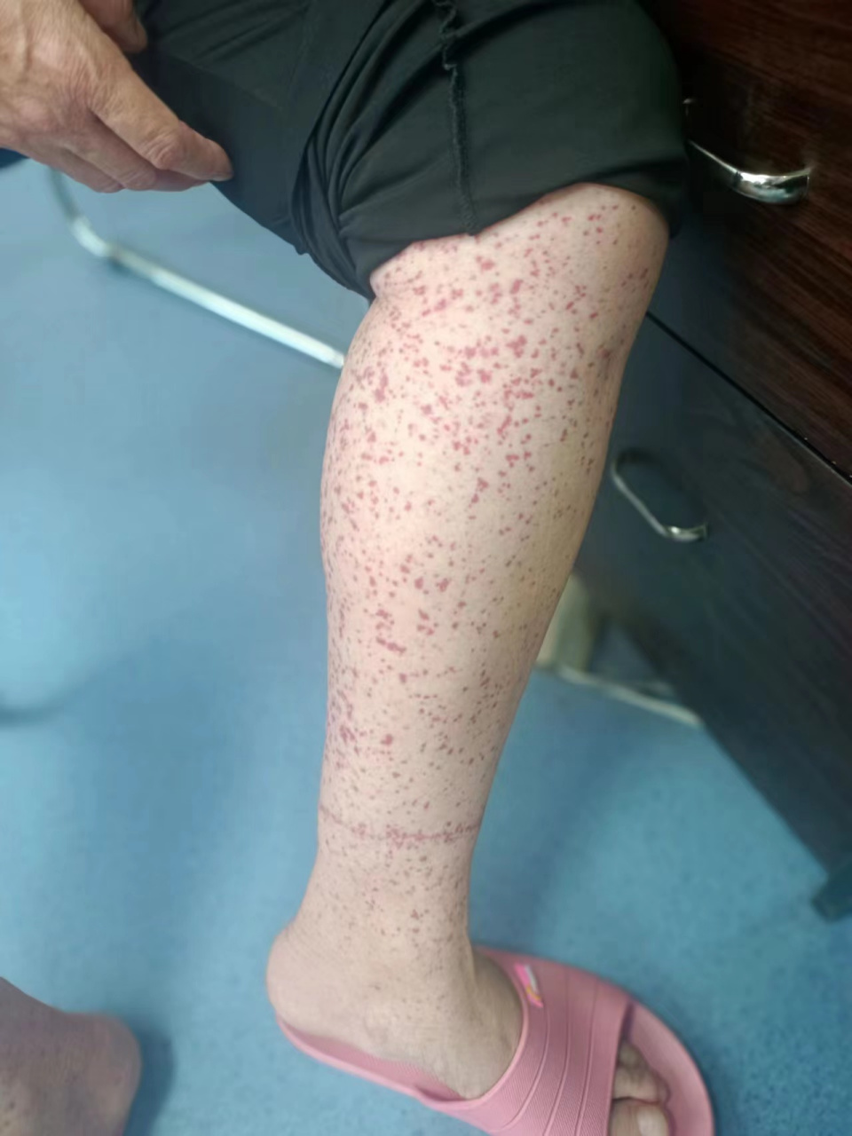 一开始类似于红色的皮疹,有的人会有一点痒,高出于皮肤,按压后不褪色