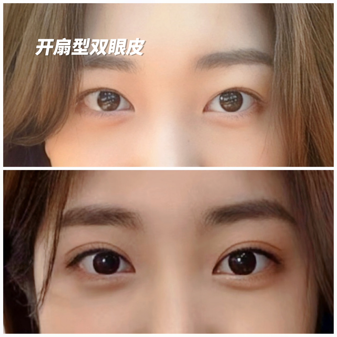最近面诊还是有小姑娘在问,开扇型双眼皮和平行型的双眼皮到底有拭创