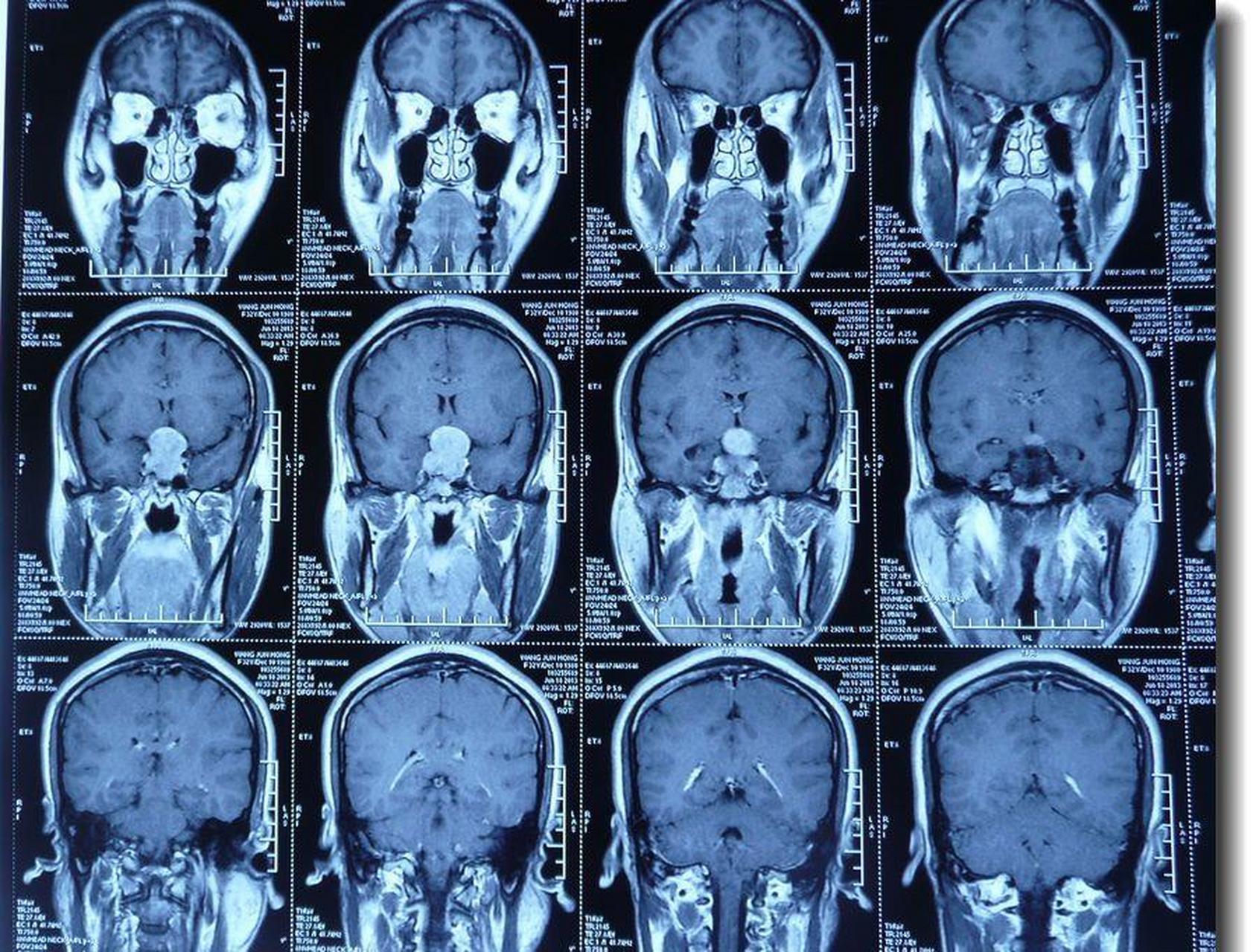 【垂体瘤开颅手术切除案例】 患者女,32岁.