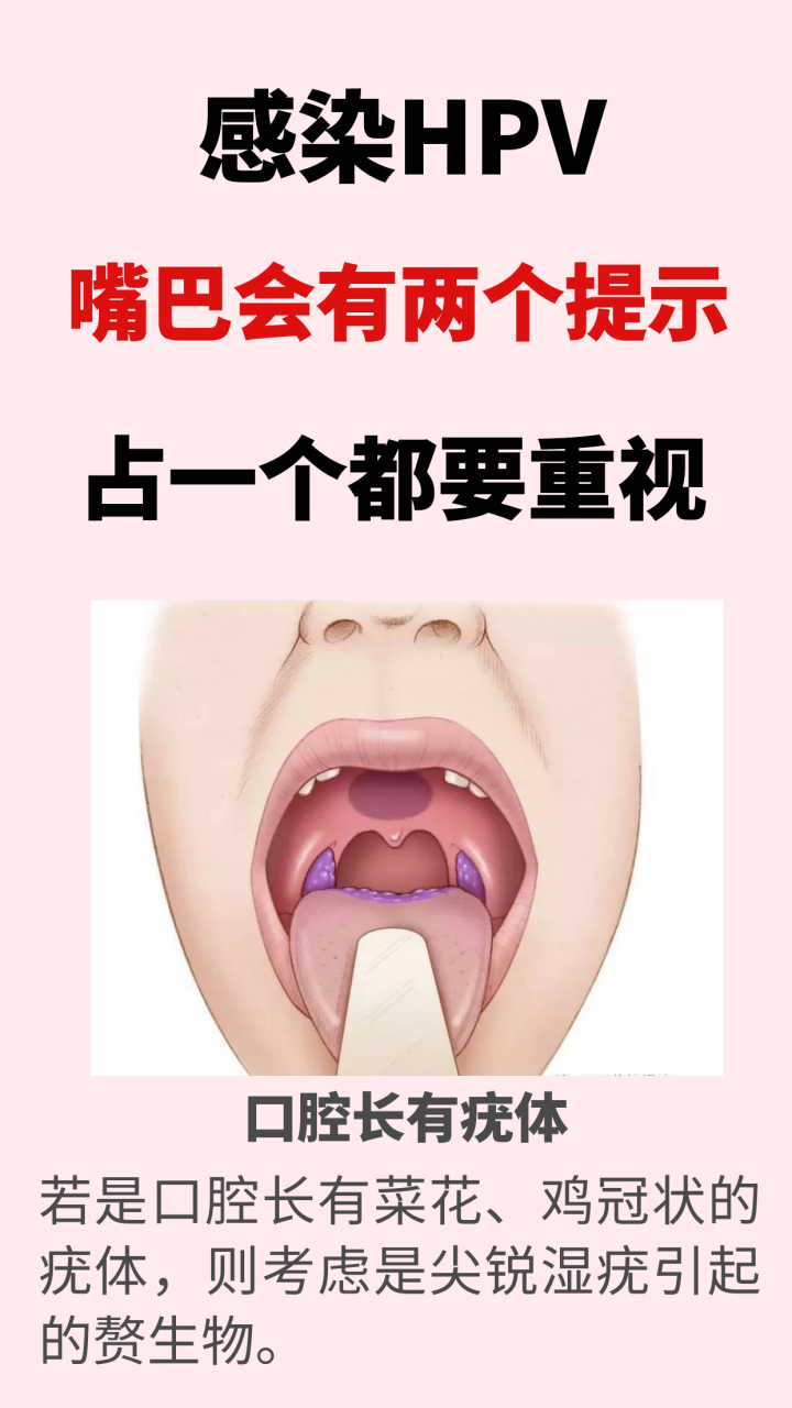 怎样确定口腔内感染hpv图片