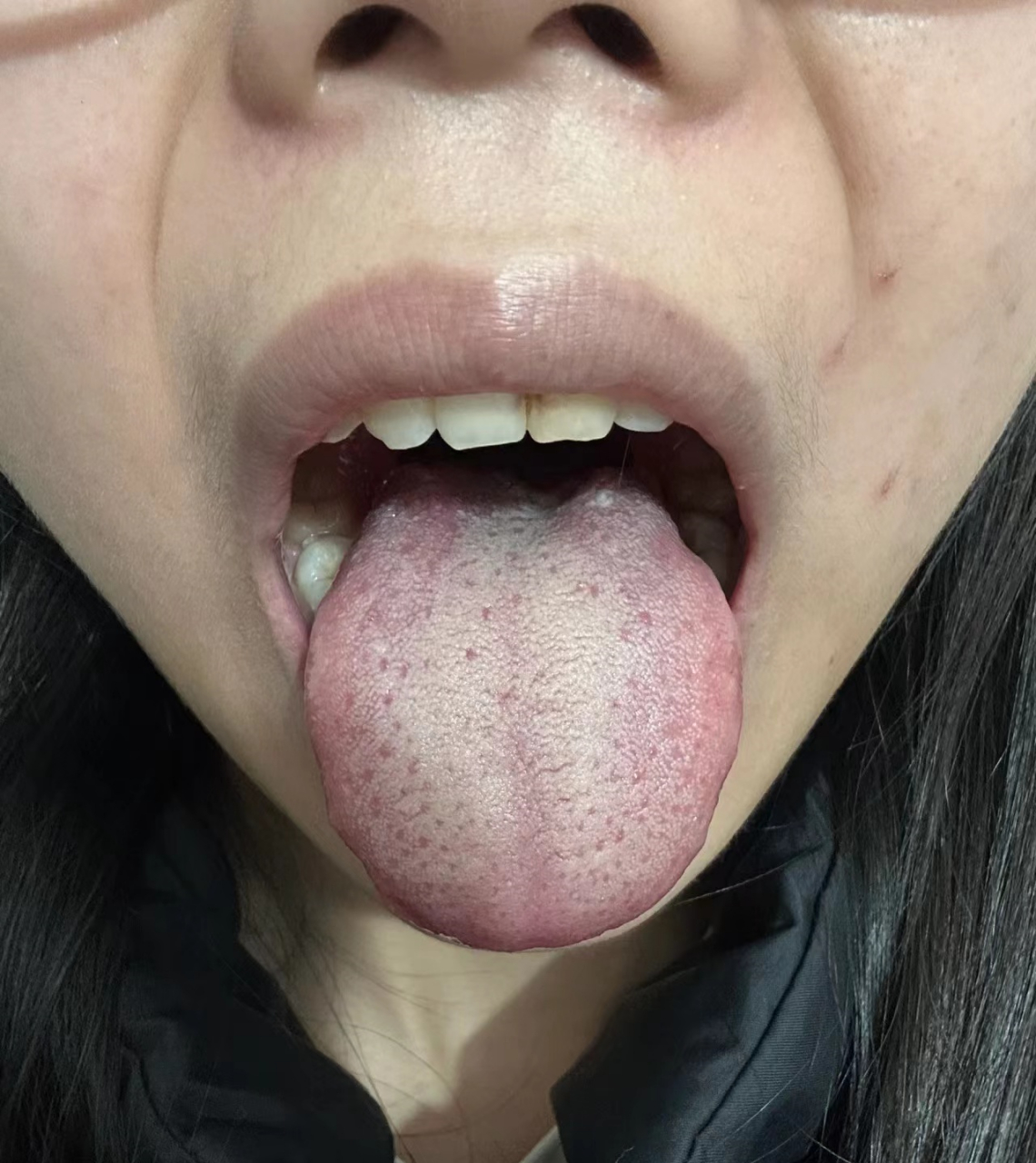 1舌根凹陷,明显肾气不足,容易腰膝酸软,耳鸣头晕,乏力,舌根舌苔发黄