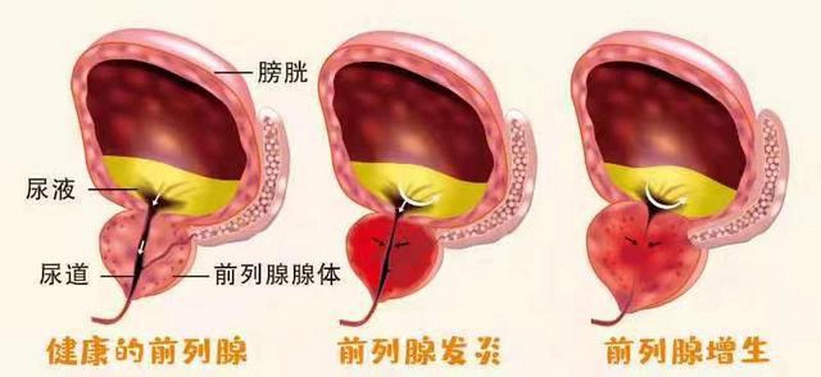 老龄 前列腺增生发病随年龄增大而增加.