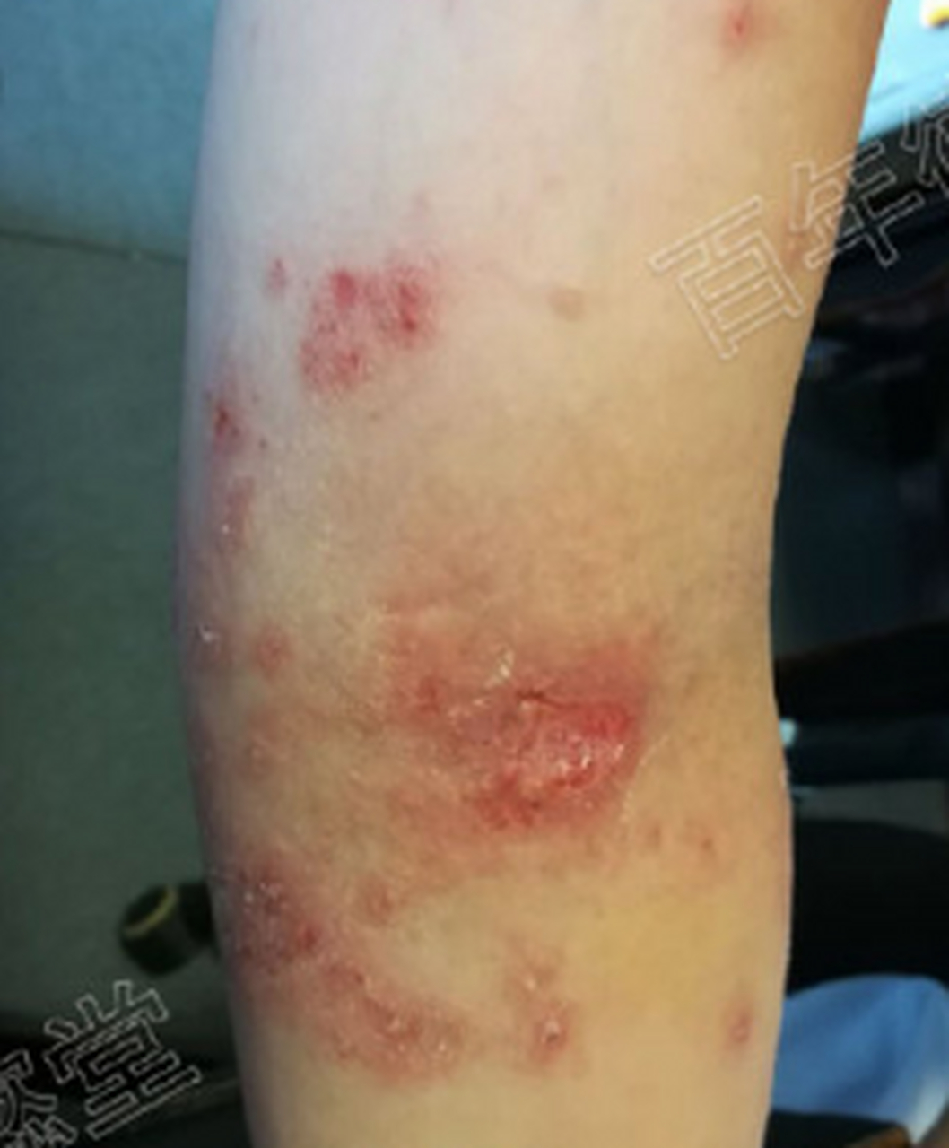 四弯风 四弯风,现代医学称之为异位性皮炎,过敏性湿疹等,以多行性皮损