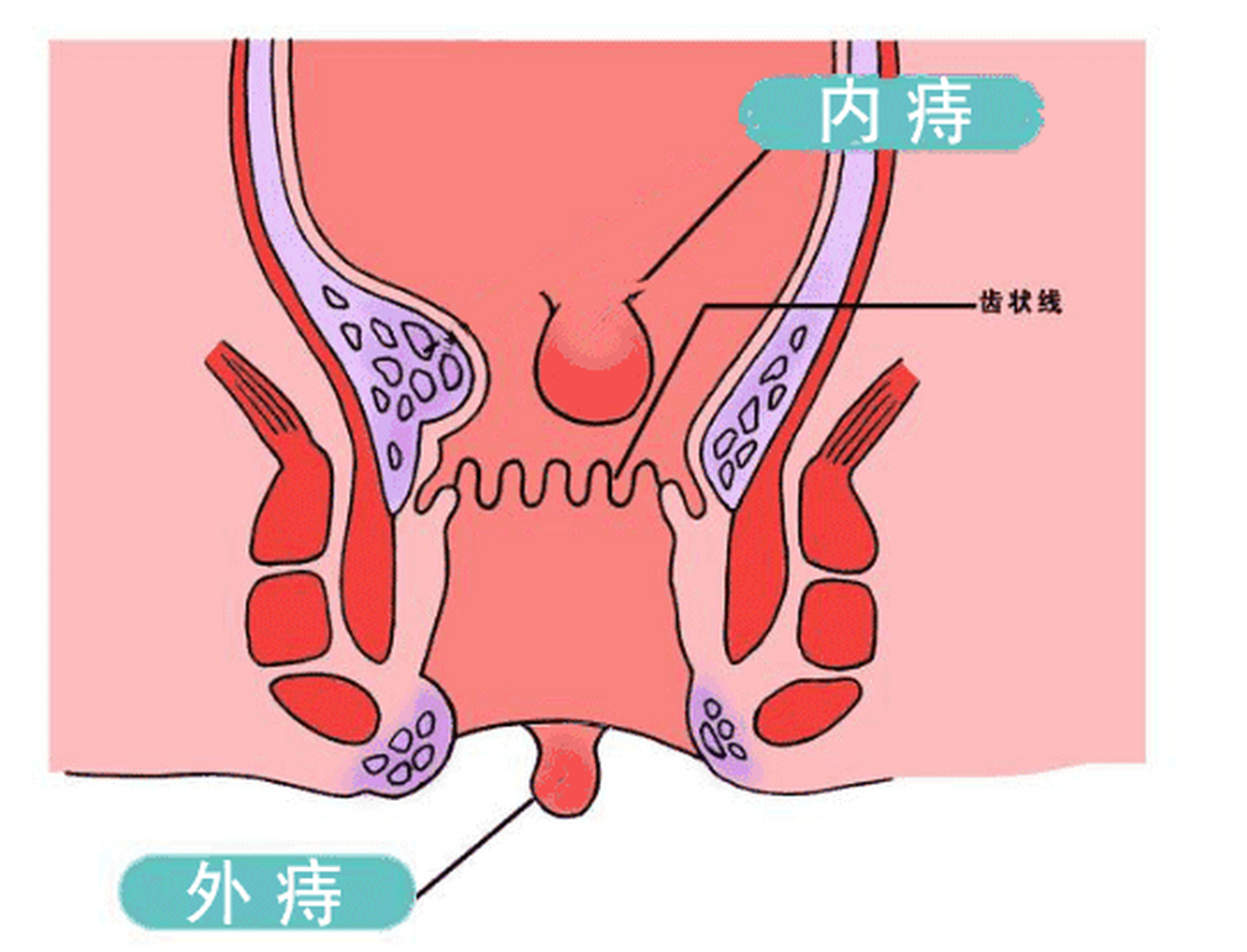 瘘疮和痔疮的区别图片图片