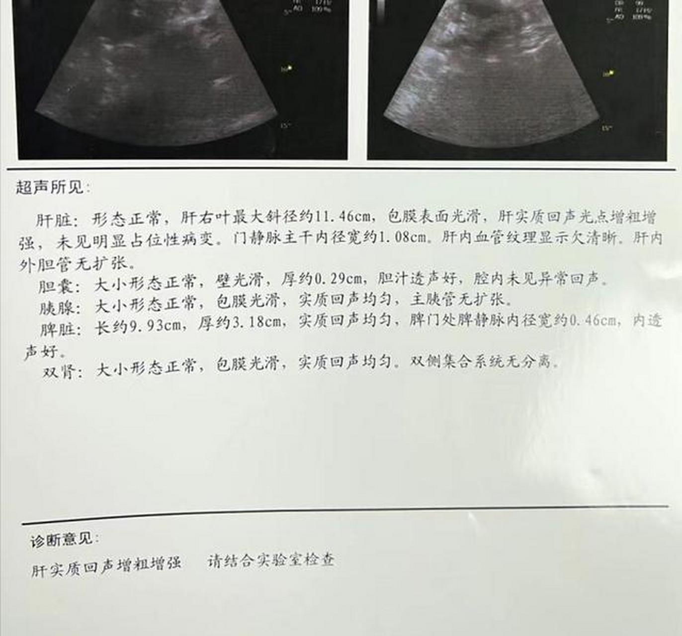 肝脏彩超报告出现这7种提示,要提高警惕 1.