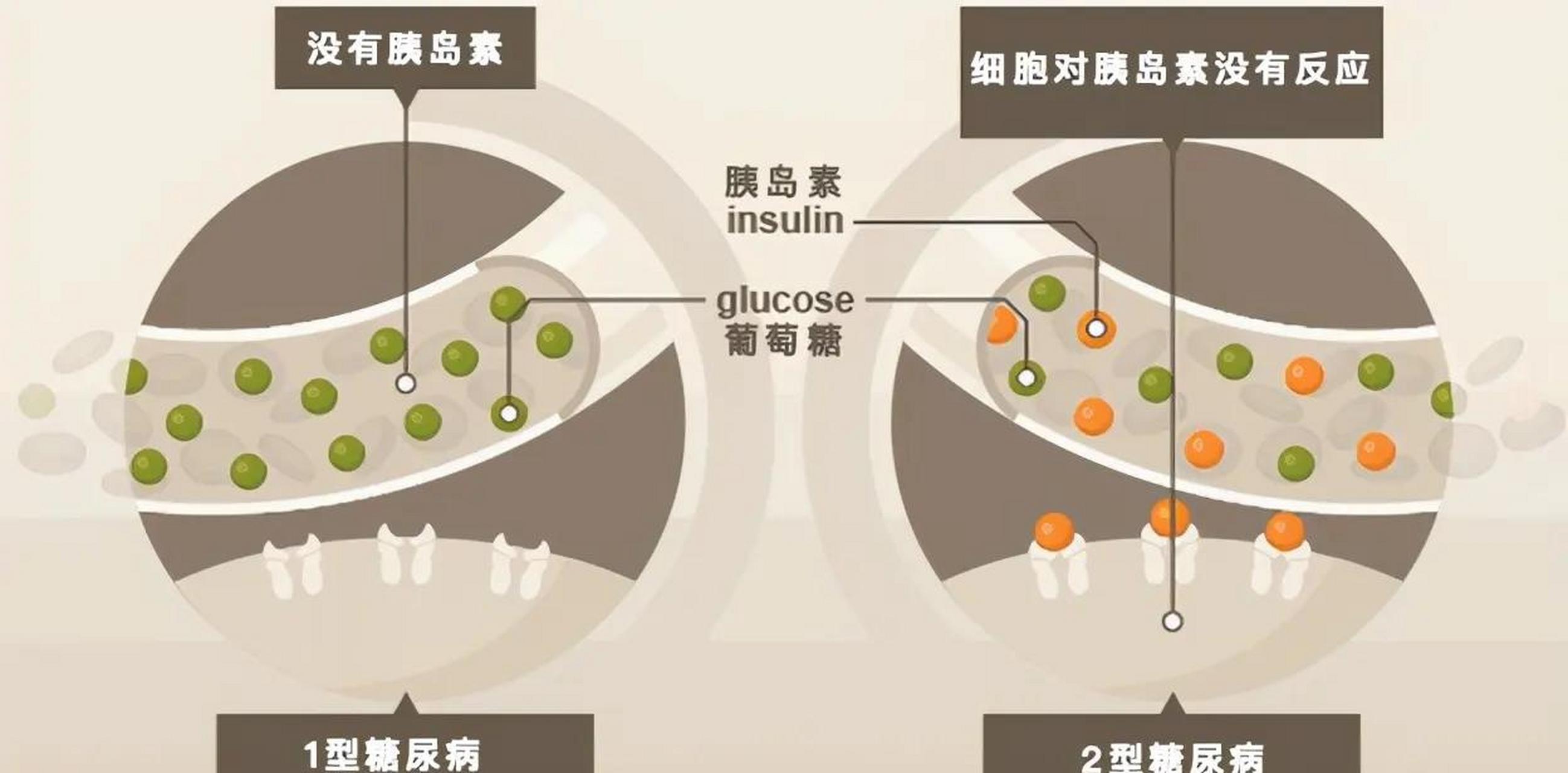 一型、二型、三型糖尿病区别详解缩略图