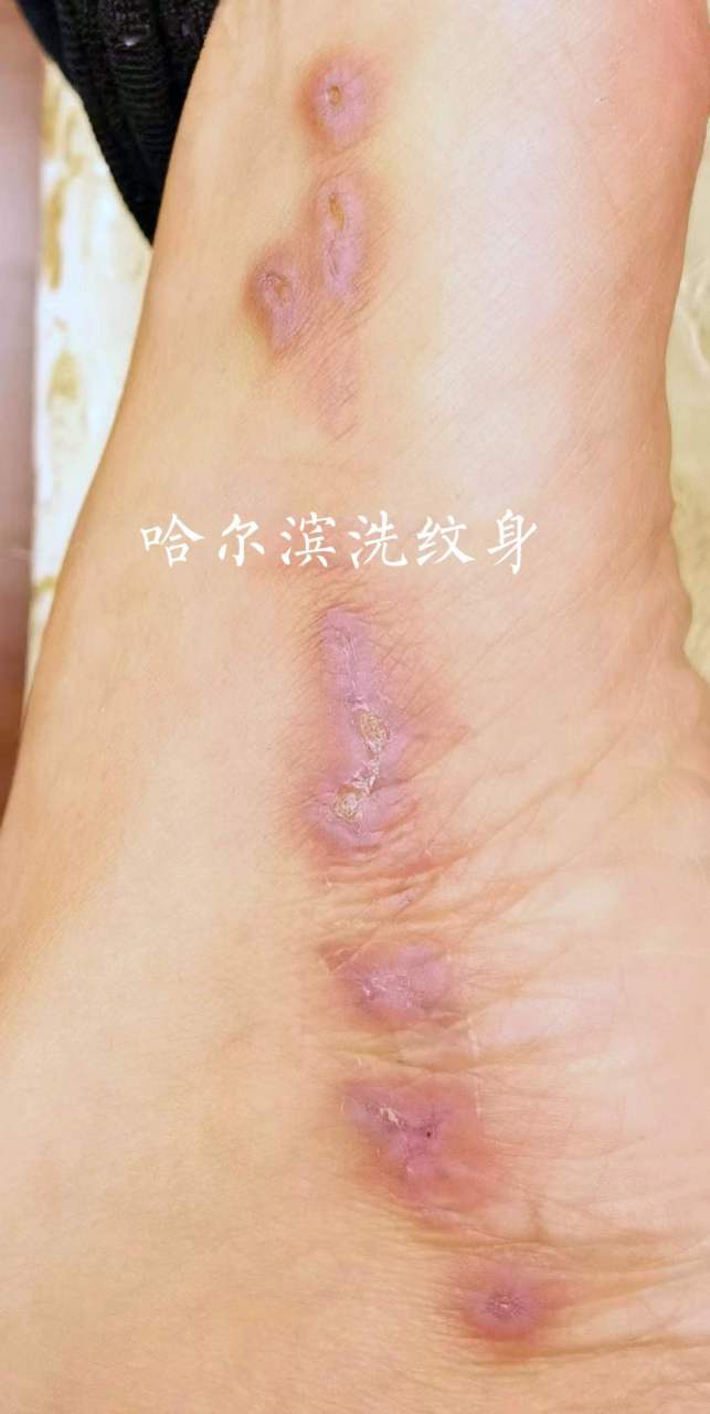 参军,空乘,公务员可以考虑一次性去除.#哈尔滨洗纹身# #一次性洗纹身